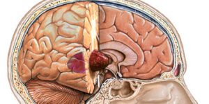 cerebro y tratamiento radioterapia