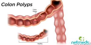 colon polyps symptoms