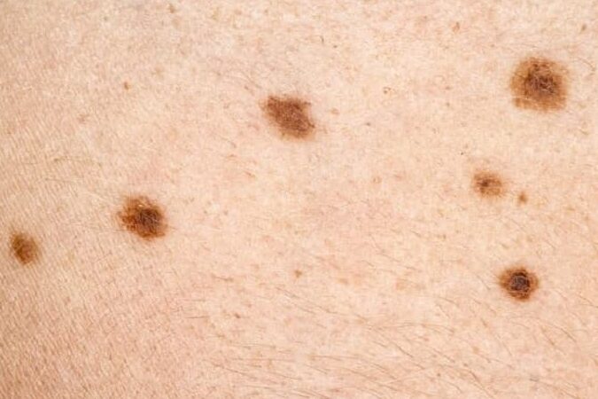 dermatologia y cancer de piel