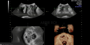 ecografia del utero