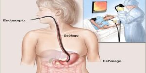 endoscopia del esofago