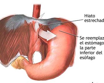 hernia de hiato postoperatoria