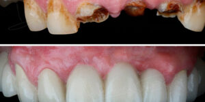 implante dental antes y despues