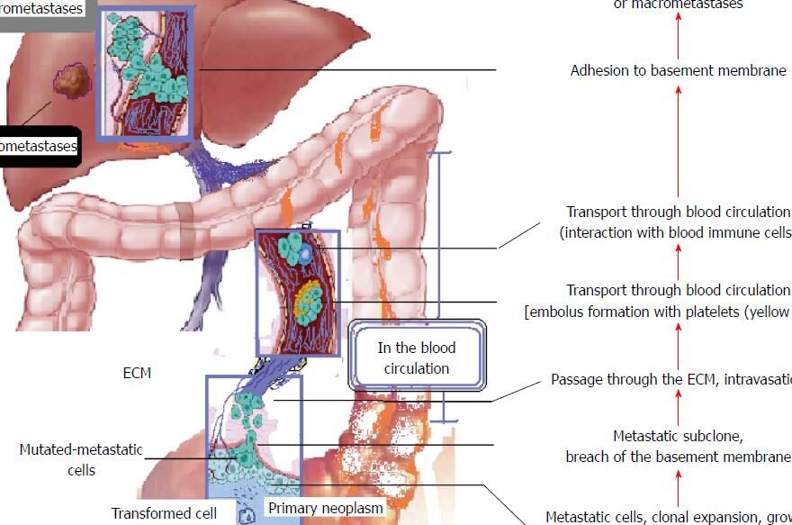 metastasis del cancer de colon