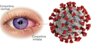 ojo afectado por conjuntivitis