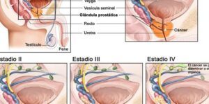 prostata y factores de riesgo