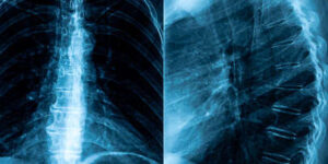 radiografia de espalda