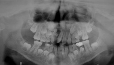 radiografia de fisura dental