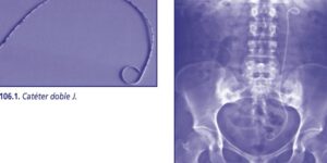 radiografia del cateter doble j