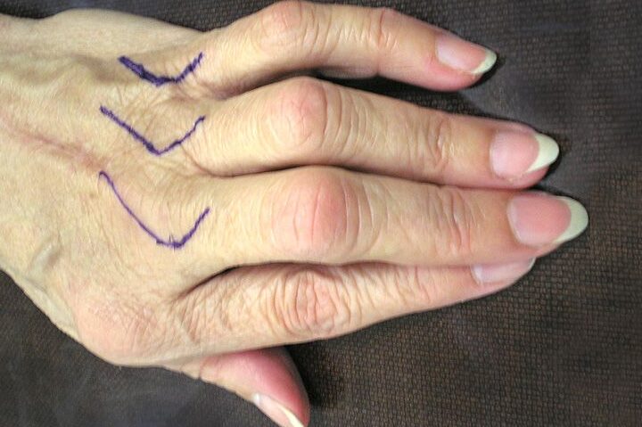 tendones de la mano
