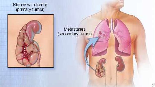 tumor renal avanzado