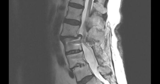 radiografia de columna vertebral