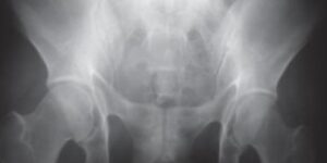 radiografia de pelvis rota