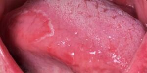sintomas de picor en lengua